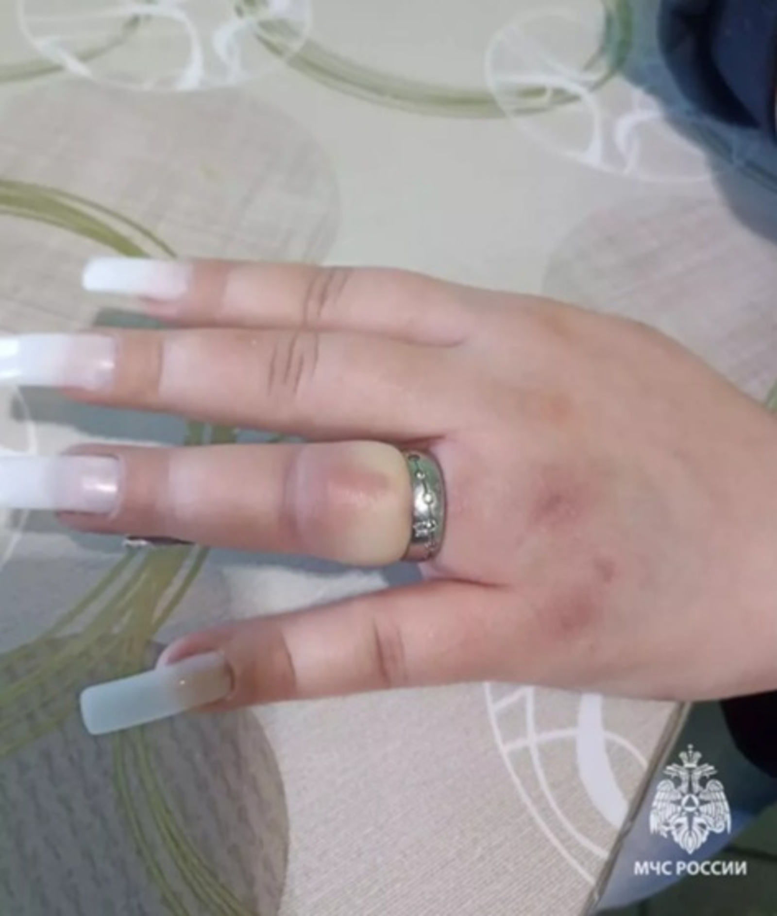 В Давлеканово женщина чуть не лишилась пальца из-за ушиба